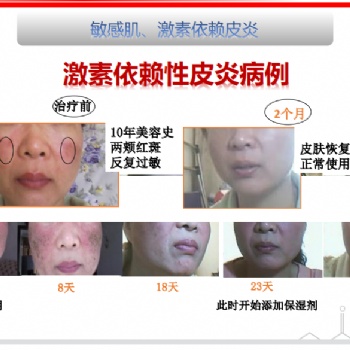 得了激素臉怎么辦:正確對(duì)待戒斷反應(yīng)，廣州怡嘉生物科技